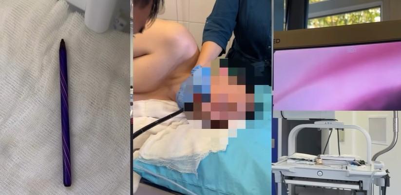 Казахстанец проглотил 26 шариковых ручек на спор