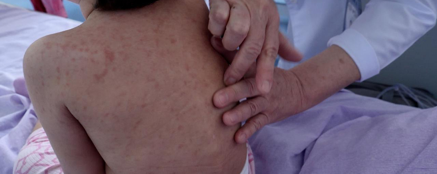 Экстренные меры вводят в Казахстане из-за вспышки кори